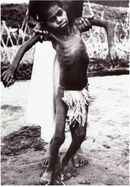 Child exhibiting symptoms of kuru