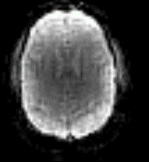 BOLD MRI image indicating brain activity